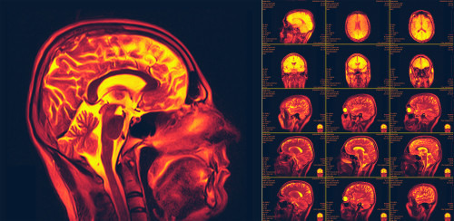 Lithium response in bipolar disorder